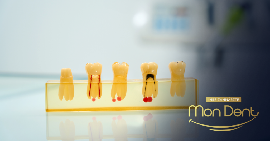 endodoncija zuba