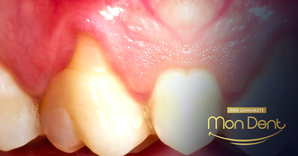 periodontal disease, periodontal disease of the tooth