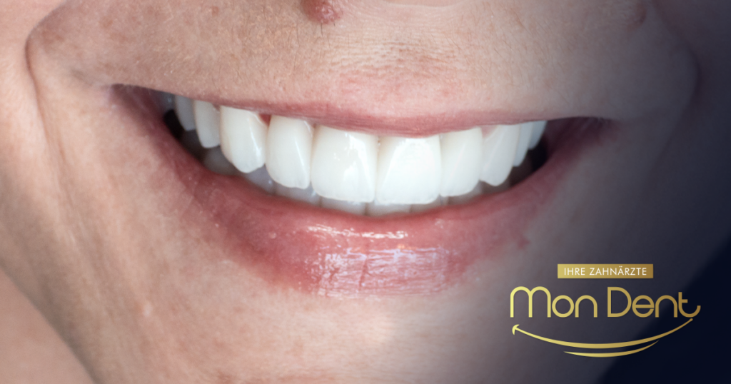 corone senza metallo, studio dentistico
